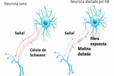 Manifiesto por el D&iacute;a Internacional de la Esclerosis M&uacute;ltiple
